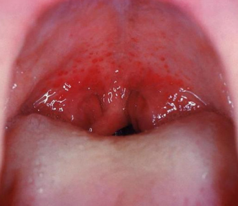 クラミジアの女性の症状　喉の写真画像